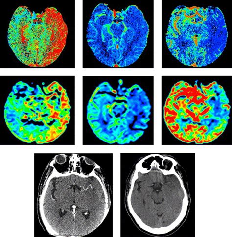 Ct Perfusion In Acute Stroke Neuroimaging Clinics