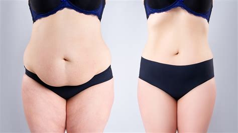 CoolSculpting Vs Liposuction Cost Results Side Effects