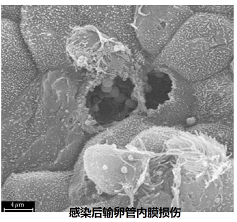 妇科沙眼衣原体感染，是“假阳性”？不，是隐形杀手