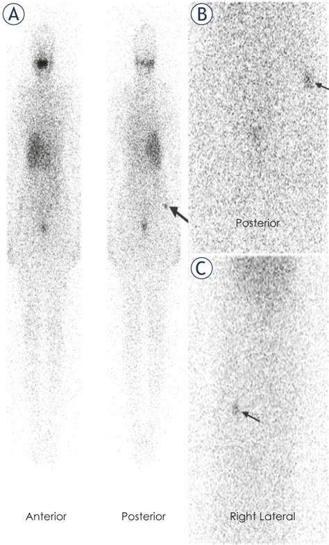 Radioactive Iodine Scan