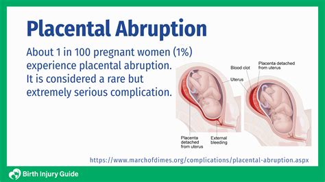 Partial Placental Abruption