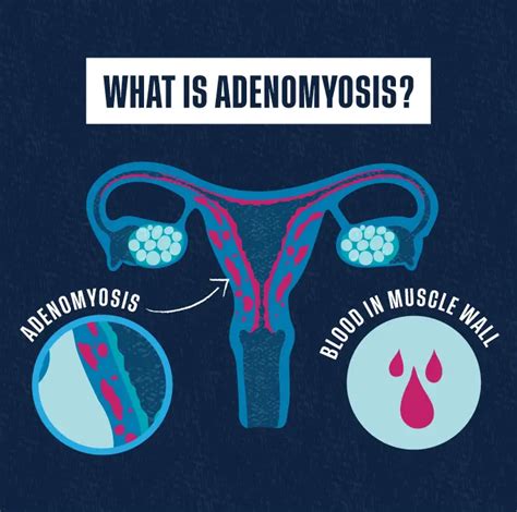 All About Adenomyosis Symptoms Causes And Treatment Libra