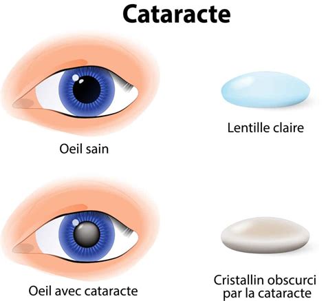 Cataracte Symptômes Prise en charge et Modes de prévention