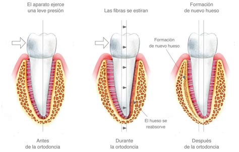 Los Movimientos Dentales Con Ortodoncia Cl Nica Ortonova Cartagena