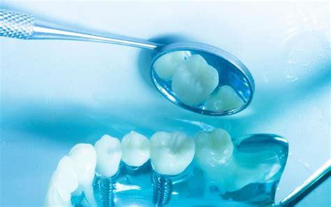 Implantes Dentales En Santa Engracia Eda Cl Nica Dental