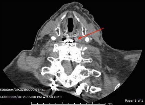 Cranial Cervical And Thoracic Computed Tomography Angiogram Revealed Download Scientific