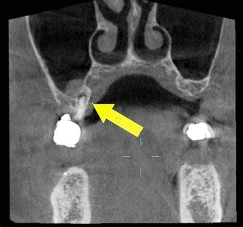 Left An Example Of Periapical Mucositis Inflammatory Change In The