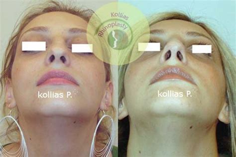 Rhinoplasty Broad Nose Tip 013 Π Κόλλιας