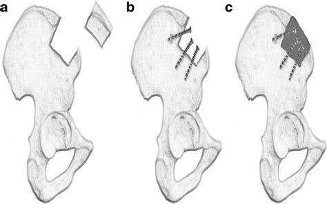 The Procedure Of Reconstruction Of The Iliac Crest After Autografting Download Scientific