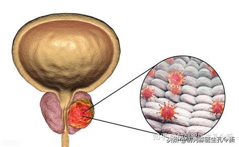 尿常规和前列腺b超满足什么情况下可以确诊前列腺炎？ 知乎