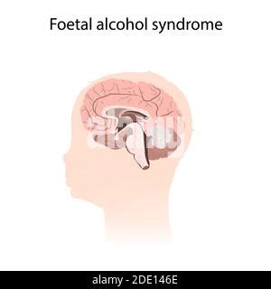 Illustration Of Baby With Fetal Alcohol Syndrome Fetal Alcohol