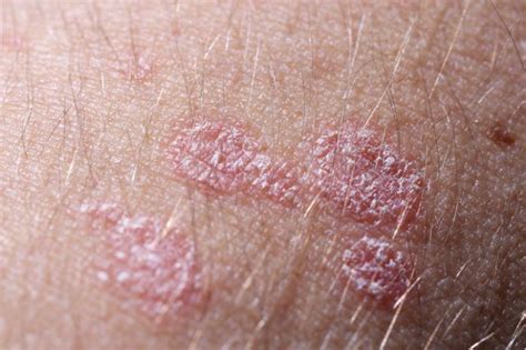 Comprendre Le Psoriasis Guttate Et Ses Traitements Efficaces