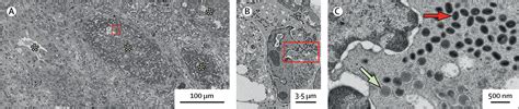 Electron Microscopy Images Of Monkeypox Virus Infection In 24 Year Old