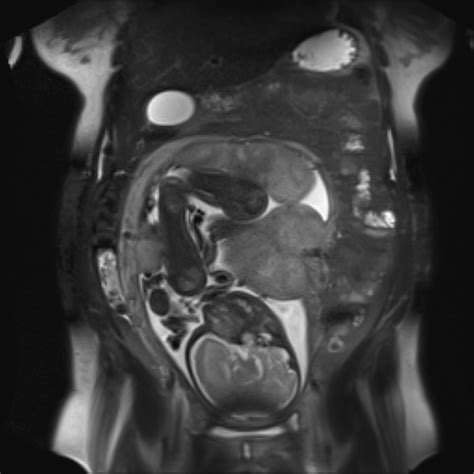 Bilobed Placenta Accreta Image Radiopaedia Org