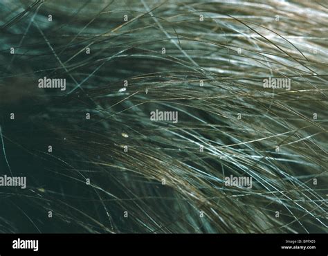 Scalp infestation hi-res stock photography and images - Alamy