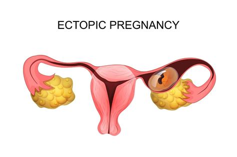 Ectopic Pregnancy: Causes, Symptoms & Treatments