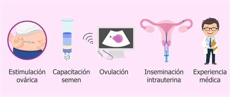 Inseminación Intrauterina NACER Centro de Reproducción Asistida