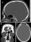 Scielo Brasil Endoscopic Management Of Frontal Sinus Csf Leaks