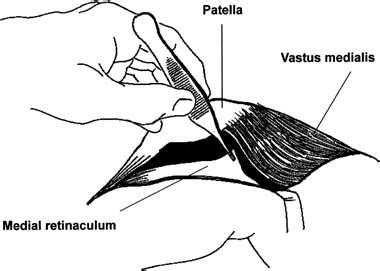 Subvastus Approach For Total Knee Arthroplasty The Journal Of