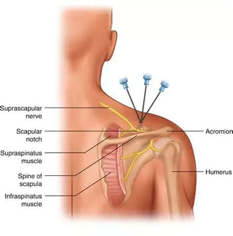 Suprascapular Block Procedure Info Pain Center Alabama