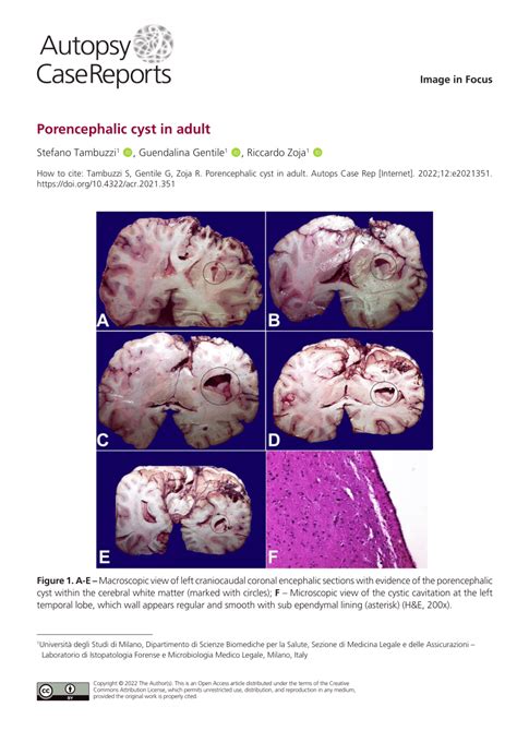 Pdf Porencephalic Cyst In Adult