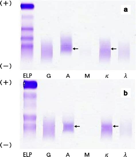 Serum and urinary immunoelectrophoresis (immunofixation method). Both ...