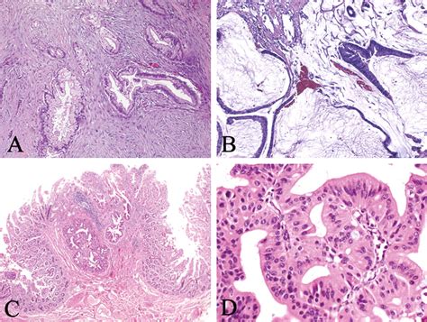 Prognosis Of Invasive Intraductal Papillary Mucinous Neoplasm Depends