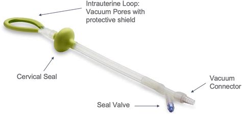 Intrauterine Devices In The Management Of Postpartum Hemorrhage