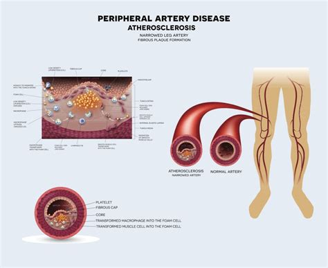 Peripheral Artery Disease Treatment Perth Dr Altaf