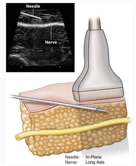 Bloqueios de Nervos Periféricos Contínuos Guiados por Ultrassom NYSORA