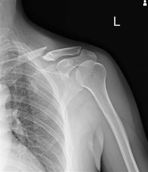 Radiografia De T Rax Fraturas Deixadas Clav Cula Costela Anterior