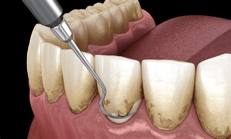 Teeth Scaling Polishing Surana Dental Clinic