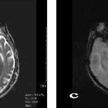 57-year-old woman with acute left cerebellar infarct. a and b ...