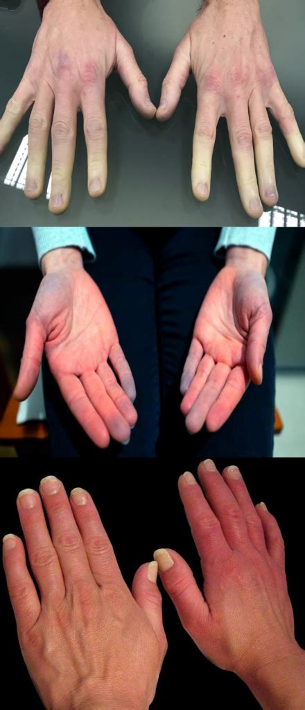 Raynaud Te informamos sobre el fenómeno de Raynaud