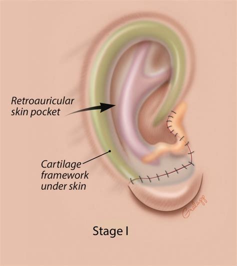 Microtia Otolaryngology⁠ — Head And Neck Surgery Stanford Medicine