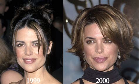 Lisa Rinna Plastic Surgery Before and After Photos - Latest Plastic ...