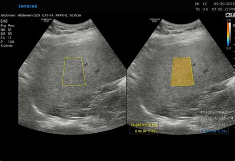 WFUMB Guidelines Guidance On Liver Multiparametric Ultrasound Part 2