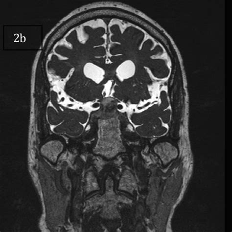 A Pre Operative T1 Weighted Mri Sagittal View B Pre Operative T2 Download Scientific