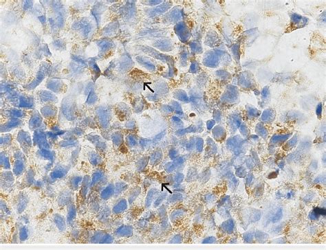 Positive Expression Of Neurofilament Protein In Neuroblasts