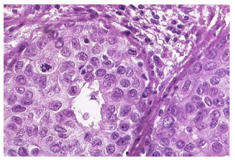 Figure 1 From Histological Typing Of Breast Tumors Semantic Scholar