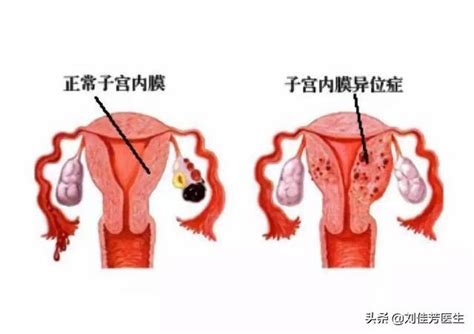 子宮內膜異位的4個徵兆，看看你的子宮，擺正位置了嗎？ 每日頭條