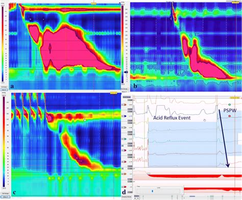 representative findings  ac high resolution manometry