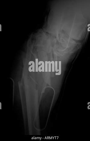 Comminuted Femur Fracture X Ray Stock Photo Alamy