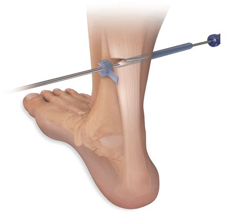 Arthrex Endoscopic Soft Tissue Release