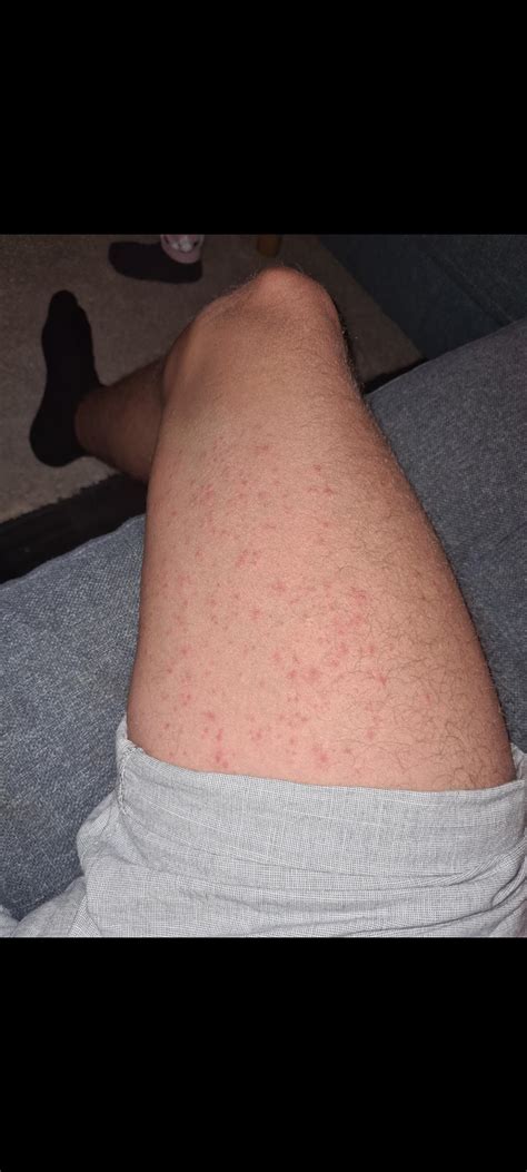 Got Folliculitis After A Bad Groin Fungal Infection Antibiotics And Cream For Three Days Now No