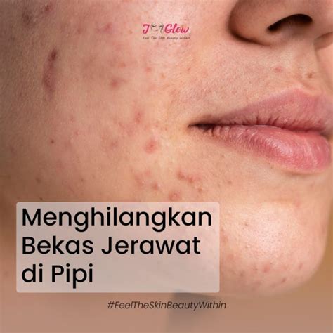 Menghilangkan Bekas Jerawat Di Pipi Jglow