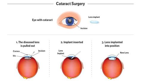 Cataract Surgery Everything You Need To Know New Life Ticket