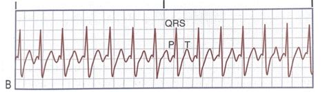 Ecg Strips Flashcards Quizlet