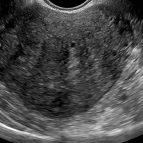 45 Years Old Woman With Pelvic Congestion Syndrome Transvaginal Us In