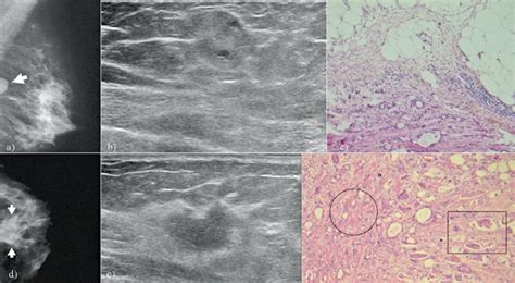 A 50 Year Old Patient With A Known Fibroadenoma In Her Left Breast